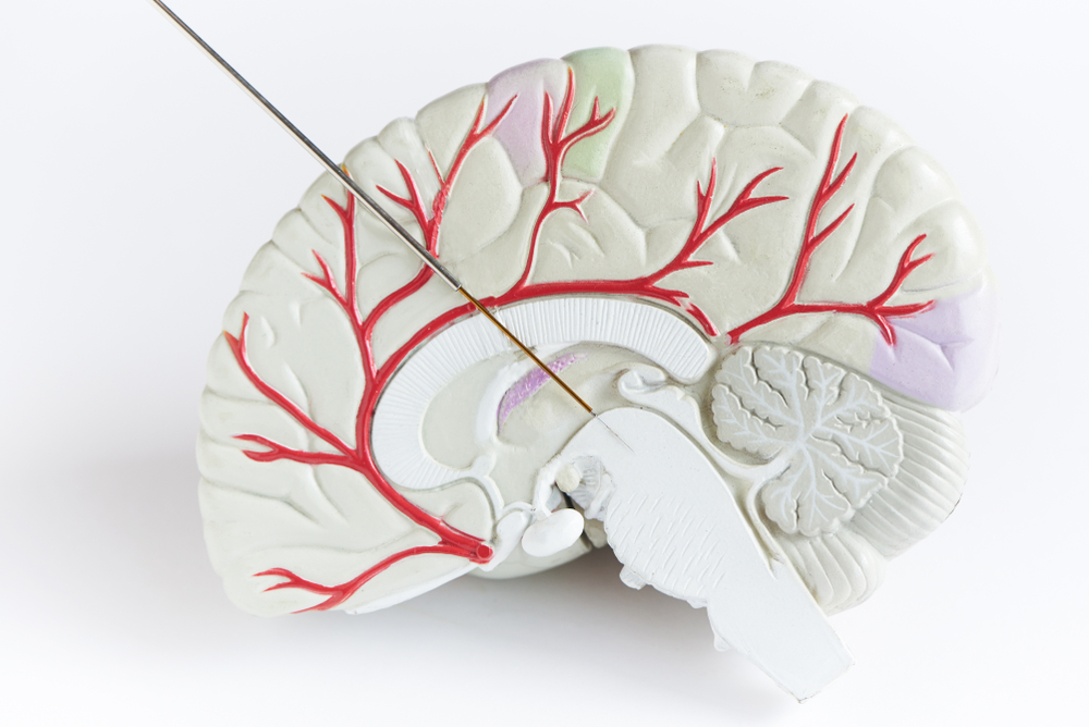 Deep Brain Stimulation Treatment In Turkey