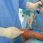 Ankle Arthroscopy kapak