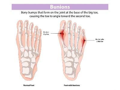 Bunion revised