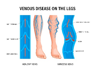aricose vein